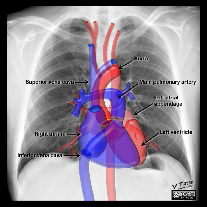 Radiopaedia - Drawing/X-ray Position of heart and great vessels in